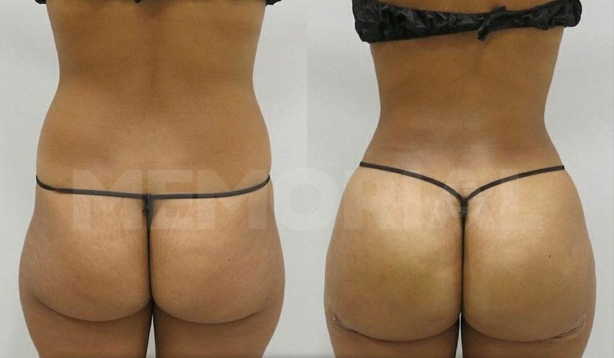 Resultados de liposucción de espalda antes y después en Memorial Şişli Hospital, mejor contorno