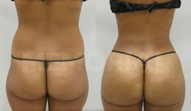 Back liposuction before and after results at Memorial Şişli Hospital, improved body contour