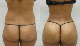 Back liposuction before and after results at Memorial Şişli Hospital, improved body contour