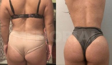 Before and after back liposuction results at Memorial Şişli Hospital, improved body contour