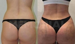 Before and after back liposuction results at Memorial Şişli Hospital, improved body contour