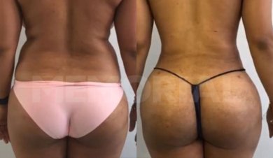 Before and after back liposuction results at Memorial Şişli Hospital, improved body contour