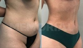 Before and after back liposuction results at Memorial Şişli Hospital, improved body contour