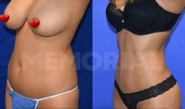 Before and after back liposuction results at Memorial Şişli Hospital, improved body contour