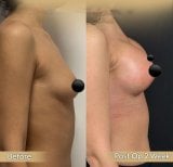 Before and after breast augmentation with fat transfer results at Dr. Safa Manav Clinic