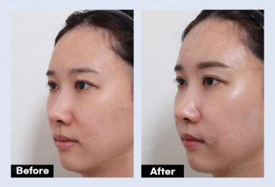 Before and after mini facelift results at URBAN Plastic Surgery, visible facial rejuvenation