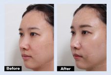 Before and after mini facelift results at URBAN Plastic Surgery, visible facial rejuvenation