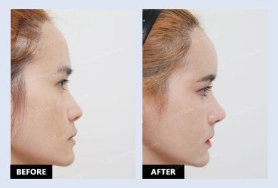 Resultados de minilifting facial antes y después en URBAN Plastic Surgery, mejora del contorno