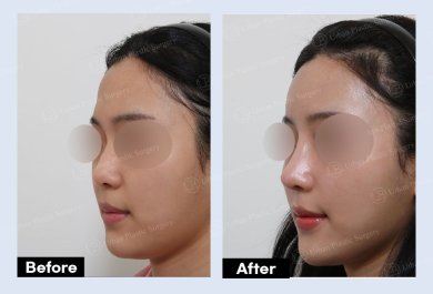 Mini facelift before and after results at URBAN Plastic Surgery – visible facial contour lift