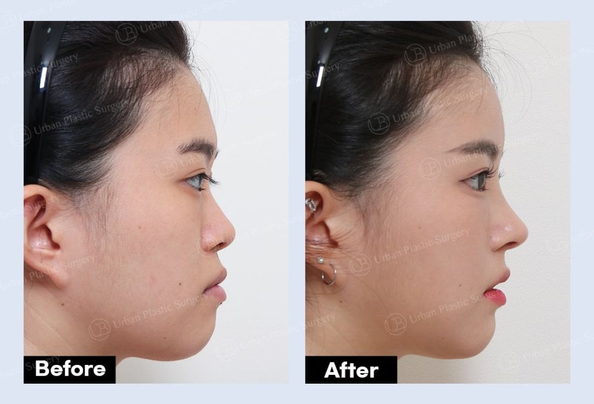 Результати міні-фейсліфтингу до і після в URBAN Plastic Surgery, покращення контуру обличчя