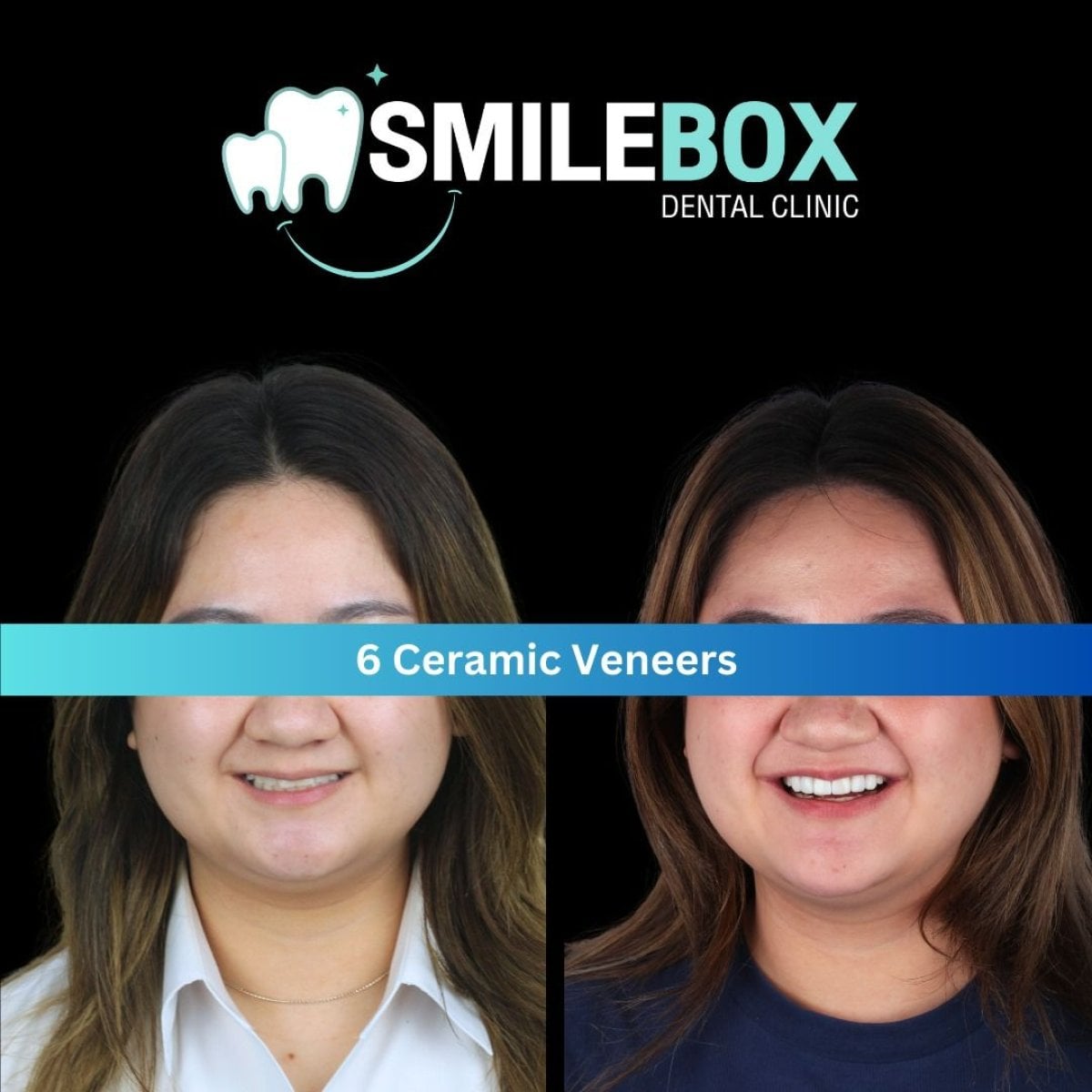 Resultados antes y después de 6 carillas cerámicas en SmileBox Dental Clinic - Thonglor
