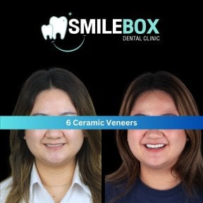 Vorher-nachher-Ergebnisse von 6 Keramikveneers bei SmileBox Dental Clinic - Thonglor