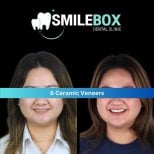 Vorher-nachher-Ergebnisse von 6 Keramikveneers bei SmileBox Dental Clinic - Thonglor