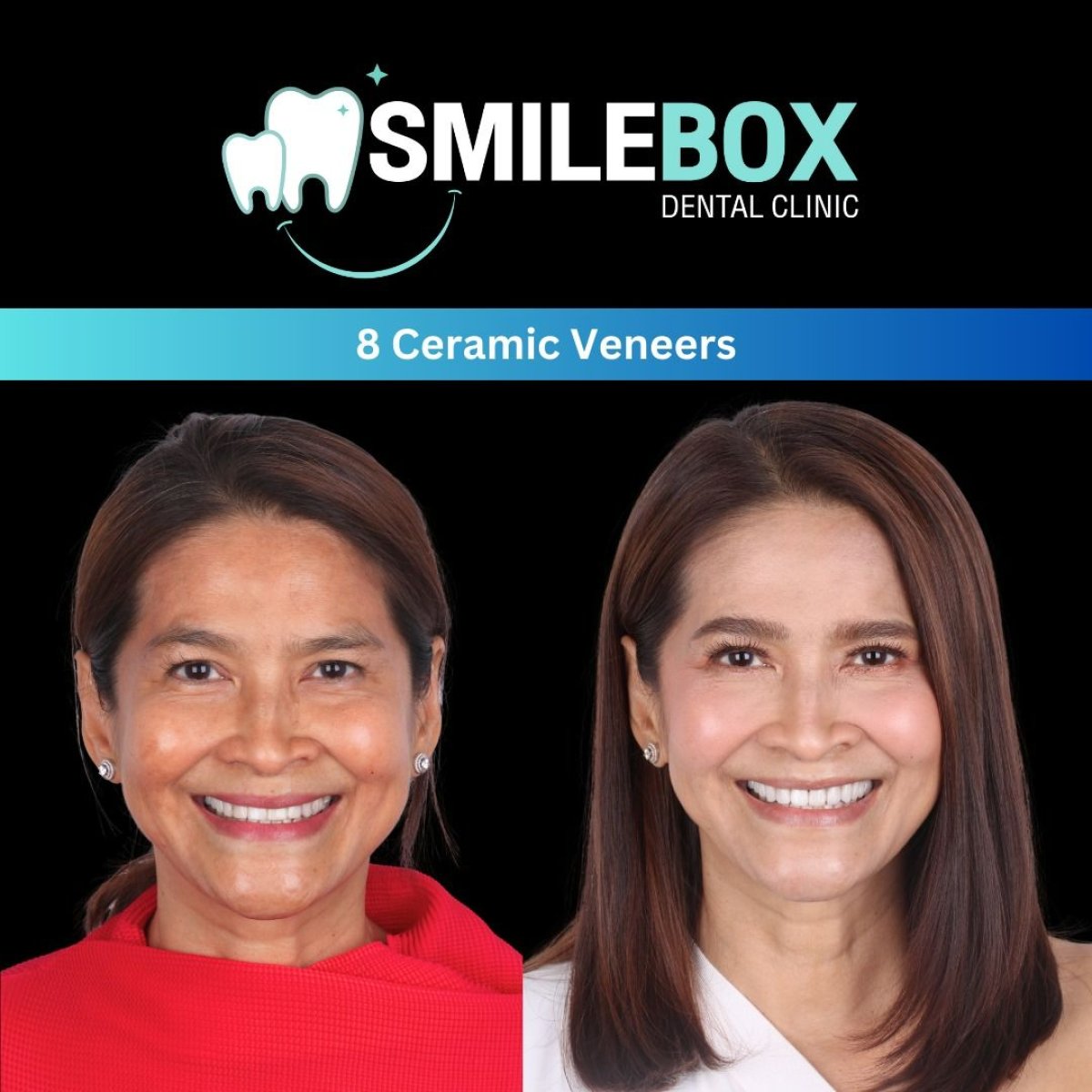 Resultados antes y después de 8 carillas cerámicas en SmileBox Dental Clinic - Thonglor