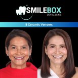 Vorher-nachher-Ergebnisse von 8 Keramikveneers bei SmileBox Dental Clinic - Thonglor