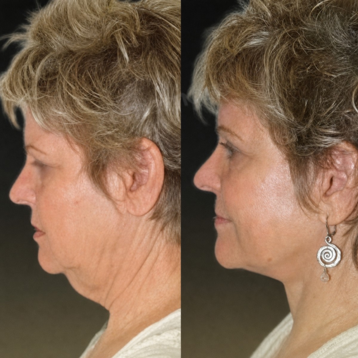 Resultados de lifting facial endoscópico antes y después en Memorial Şişli Hospital, cuello definido