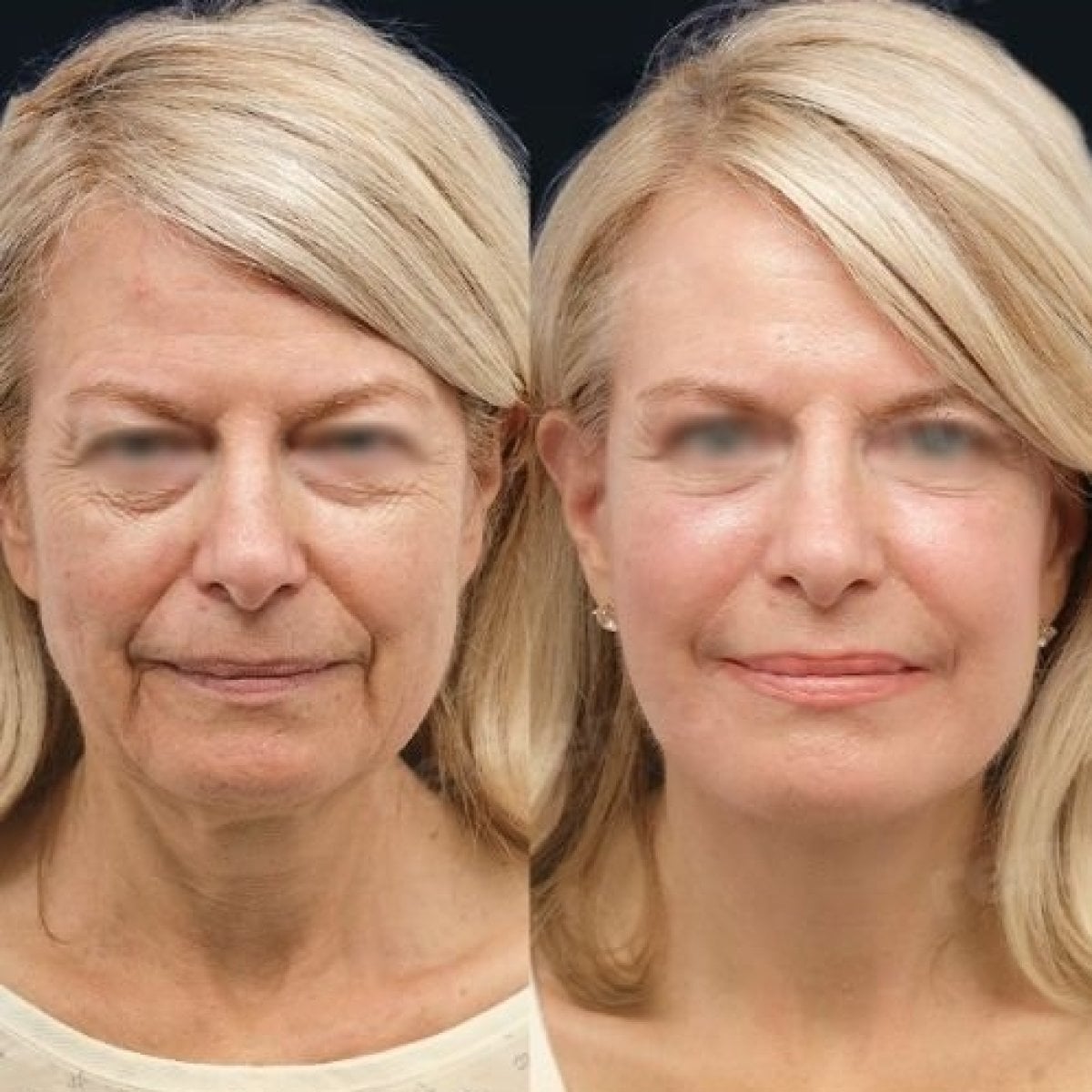 Resultados antes y después de lifting endoscópico facial en Memorial Şişli Hospital, rejuvenecimiento