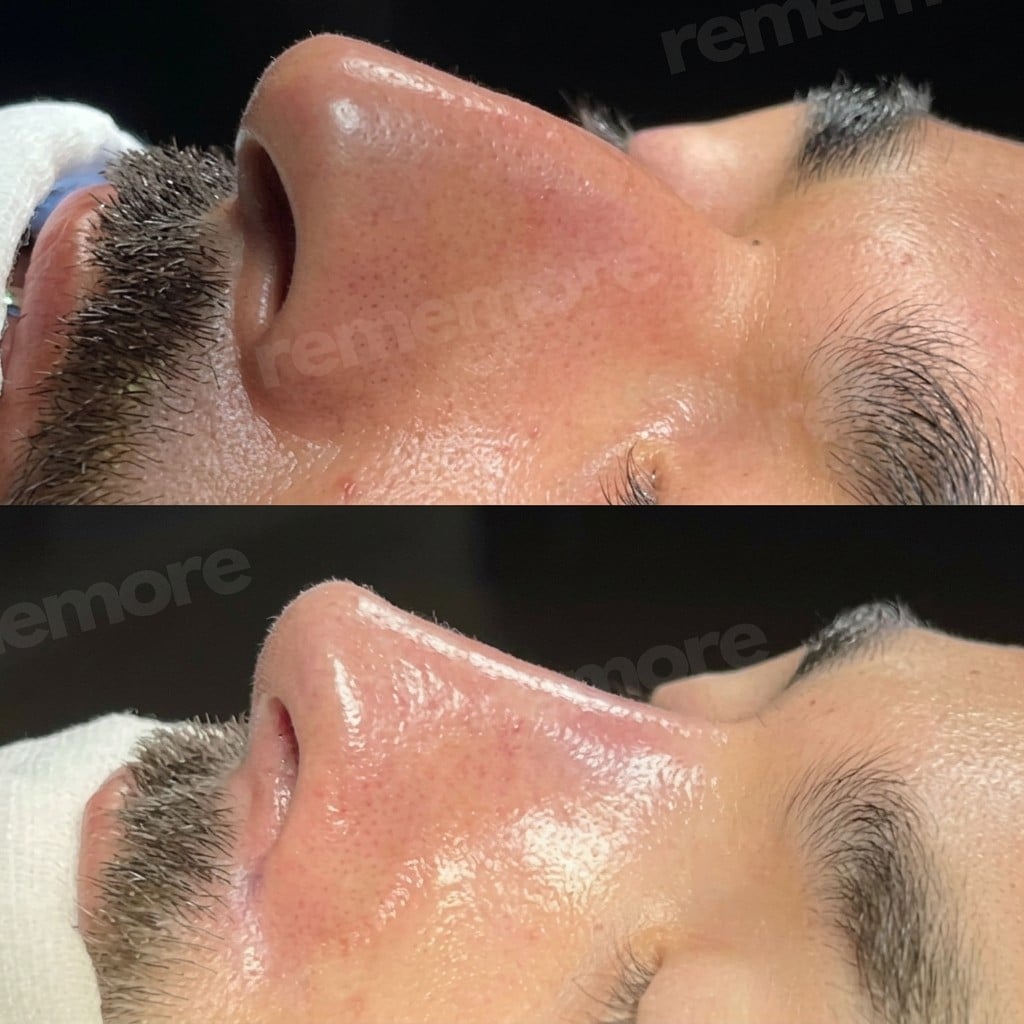 نتائج قبل وبعد تجميل طرف الأنف في مستشفى ميموريال شيشلي، شكل أنف محسّن
