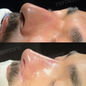 Before and after tip rhinoplasty results at Memorial Şişli Hospital, refined nose shape