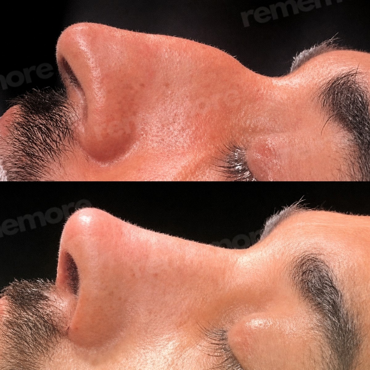 نتائج تجميل طرف الأنف قبل وبعد في مستشفى ميموريال شيشلي، شكل أنف محسن
