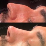 Before and after tip rhinoplasty results at Memorial Şişli Hospital, refined nose shape