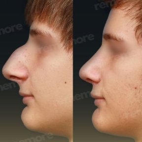 Before and after tip rhinoplasty results at Memorial Şişli Hospital, improved nose profile