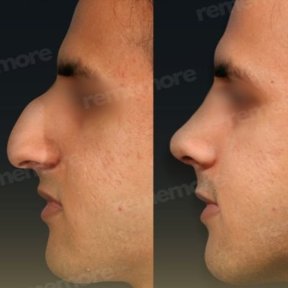 Before and after tip rhinoplasty result at Memorial Şişli Hospital, improved nose profile