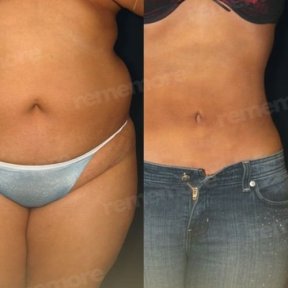 Before and after liposuction results at Memorial Şişli Hospital, visible body contour improvement
