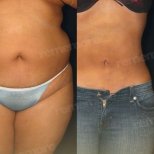 Before and after liposuction results at Memorial Şişli Hospital, visible body contour improvement