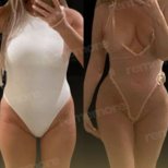 Before and after liposuction results at Memorial Şişli Hospital, improved body contour