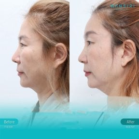 Before and after endoscopic facelift results at Wansiri Hospital, visible facial rejuvenation