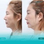 Before and after endoscopic facelift results at Wansiri Hospital, visible facial rejuvenation