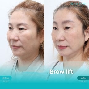 Before and after brow lift results at Wansiri Hospital, visible eyebrow and forehead lift