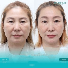 Before and after endoscopic facelift results at Wansiri Hospital, facial rejuvenation visible