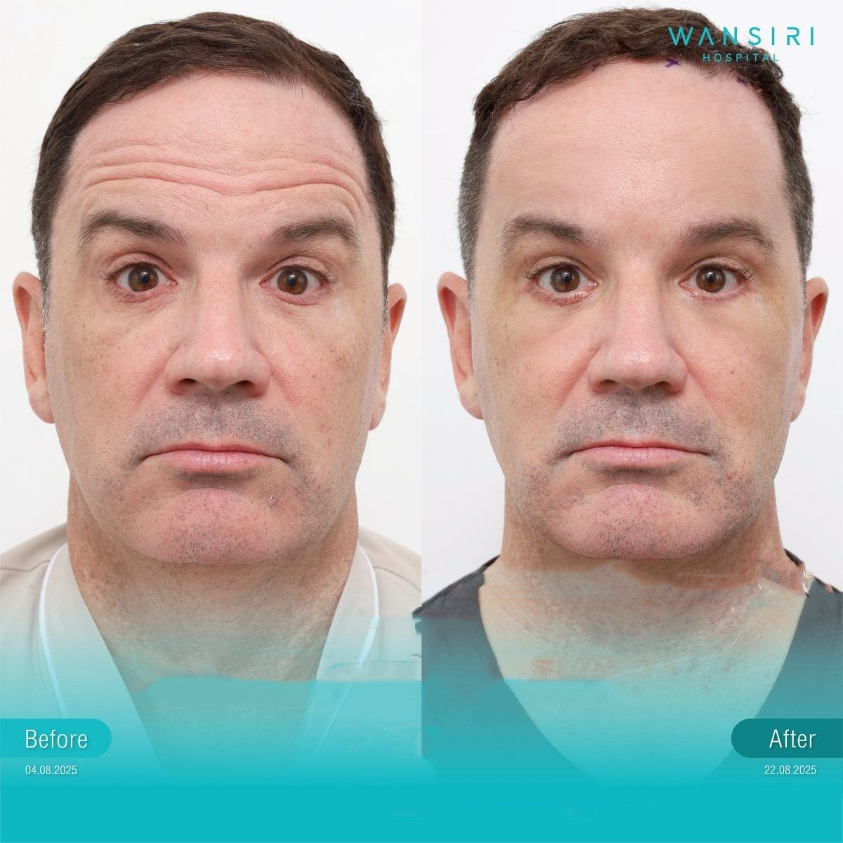 Resultados de lifting endoscópico facial antes y después en Wansiri Hospital, rejuvenecimiento