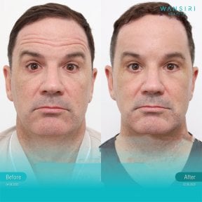 Before and after endoscopic facelift results at Wansiri Hospital, visible facial rejuvenation