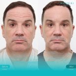 Before and after endoscopic facelift results at Wansiri Hospital, visible facial rejuvenation