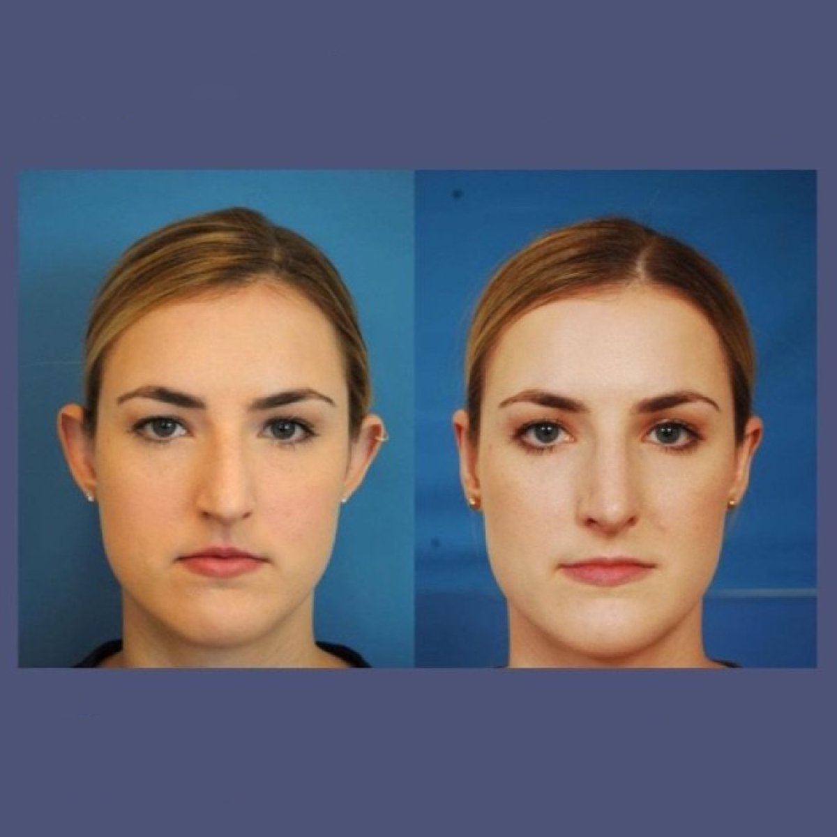 Before and after otoplasty results at ID Clinic Bangkok, ear reshaping with natural outcome