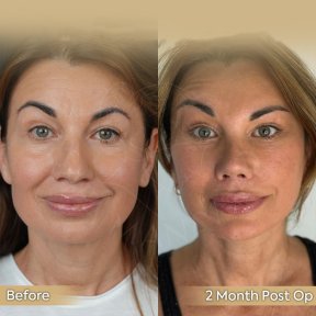 Brow Lift Vorher-Nachher-Ergebnisse bei Dr. Safa Manav Clinic, sichtbare Stirnverjüngung