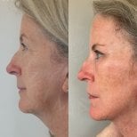 Vorher-nachher-Ergebnis Brauenlifting bei Dr. Safa Manav Clinic, sichtbare Stirn- und Augenanhebung