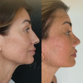 Vorher-nachher-Ergebnis Brauenlifting bei Dr. Safa Manav Clinic, sichtbare Stirnanhebung
