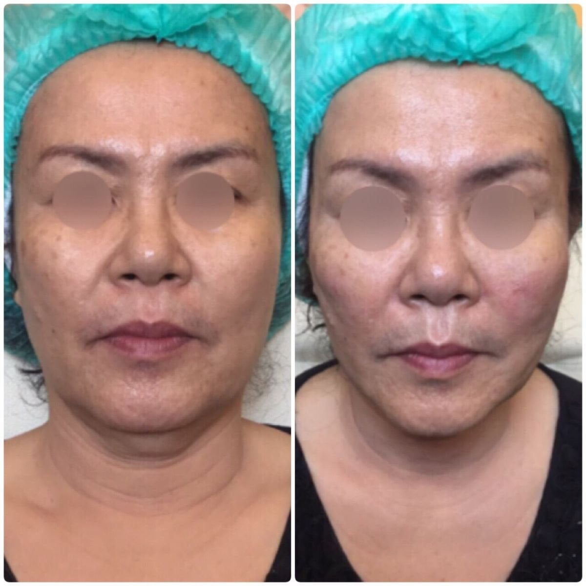 قبل وبعد حقن البوتوكس في Asia Cosmetic Hospital، تقليل واضح لتجاعيد الوجه