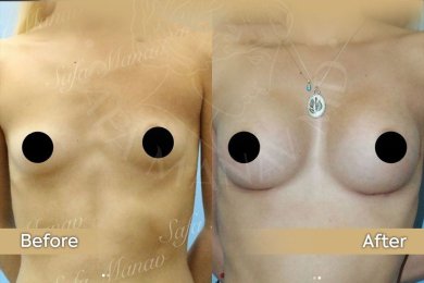 Vorher-nachher-Ergebnis Brustimplantate mit Straffung bei Dr. Safa Manav Clinic, verbesserte Form