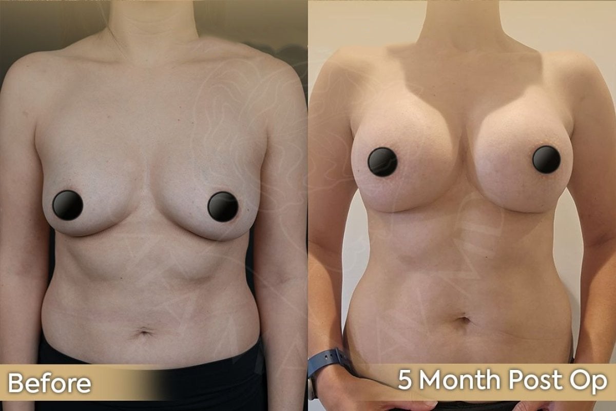 Resultados antes y después de implantes y lifting de senos en Dr. Safa Manav Clinic, 5 meses