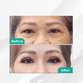 Before and after blepharoplasty results at Intrarat Hospital, eyelid correction for youthful look