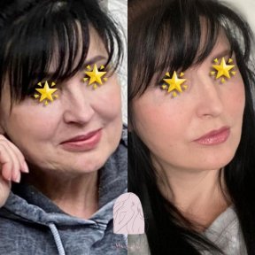 Facelift before and after results at Dr. MED – visible facial rejuvenation and smoother skin