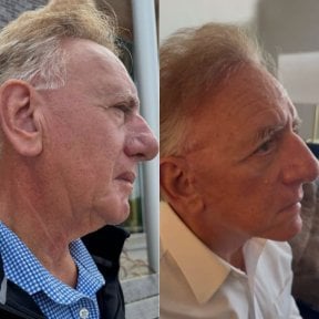 Before and after mini facelift results at CE International Hospital, visible facial rejuvenation