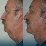 Before and after mini facelift result at CE International Hospital, visible neck and jawline lift