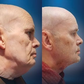 Before and after mini facelift results at CE International Hospital, visible facial rejuvenation