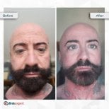 Before and after mini facelift results at CE International Hospital, visible facial rejuvenation